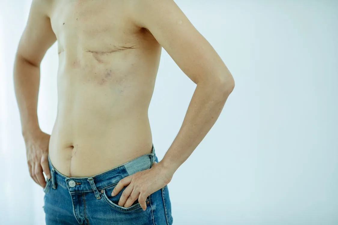 What is a Mastectomy? 