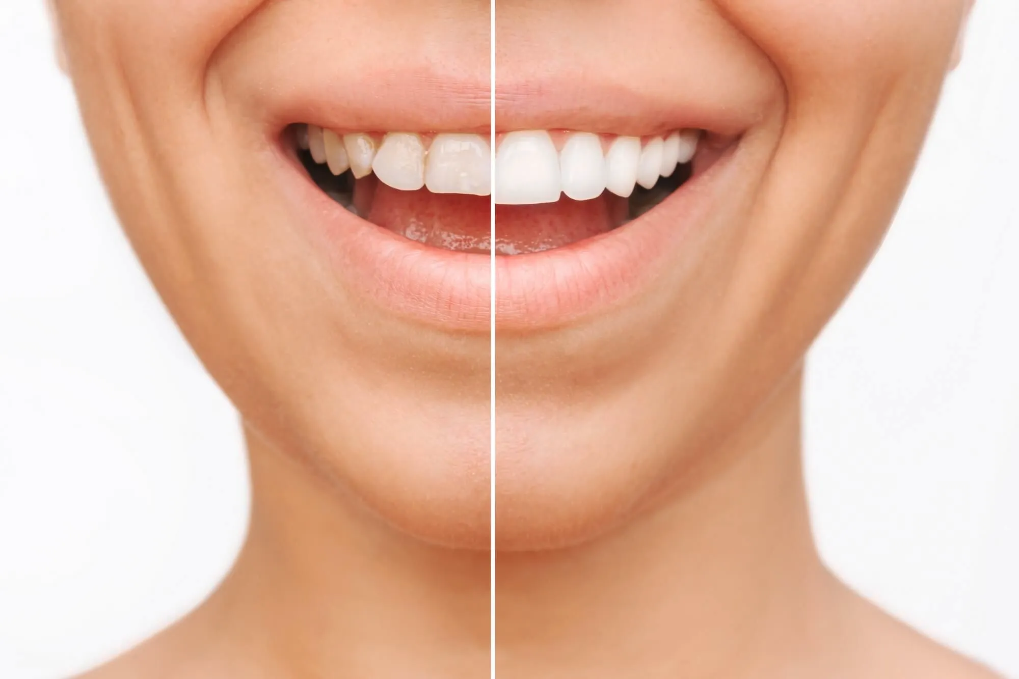 Advantages of Dental Bleaching in Iran 