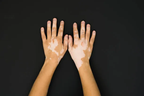 What is Vitiligo? 