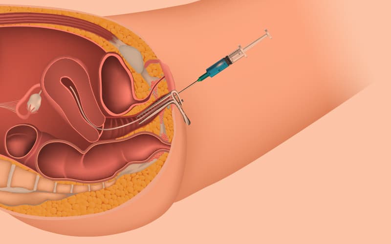 What is Artificial insemination or IUI? 