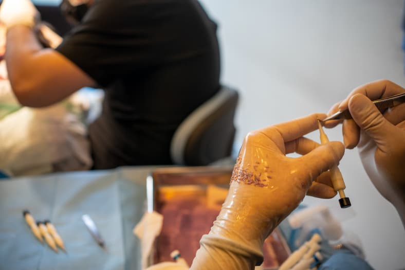 DHI vs. FUE Hair Transplant