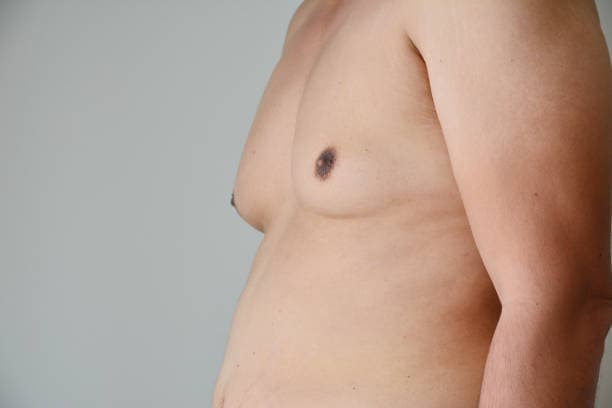 Gynecomastia Causes