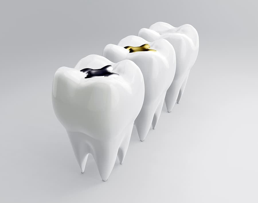 Advantages and Disadvantages of Amalgam Fillings