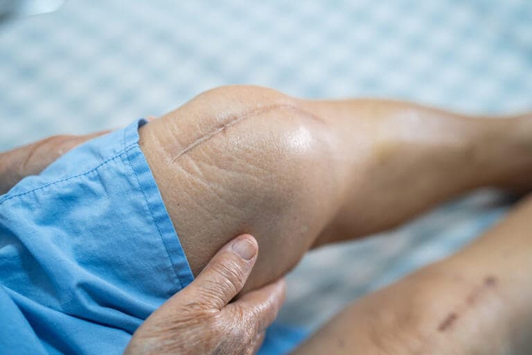 What is total knee replacement surgery?