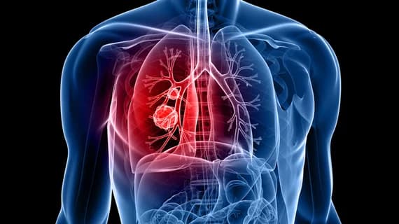 Lobectomy cost in Iran