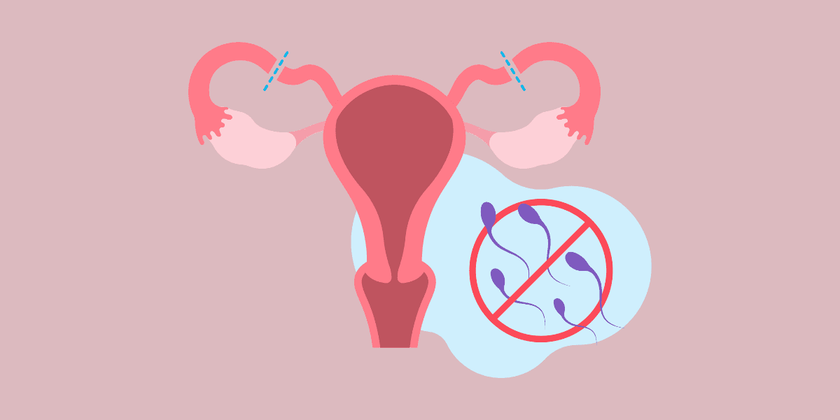 How is Female Sterilization done?