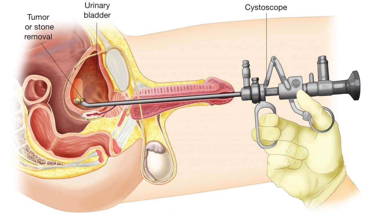 What is Urethral surgery?