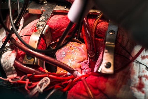 Who needs a Valve Repair?