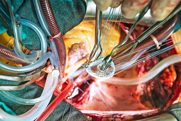 How to prepare for Valve Repair?