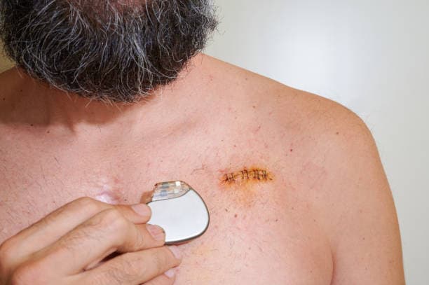 What are the signs you need a pacemaker?