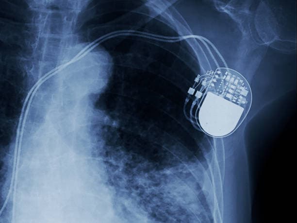 Pacemaker cost in Iran