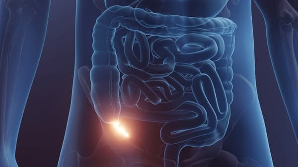 What happens during an Appendectomy?