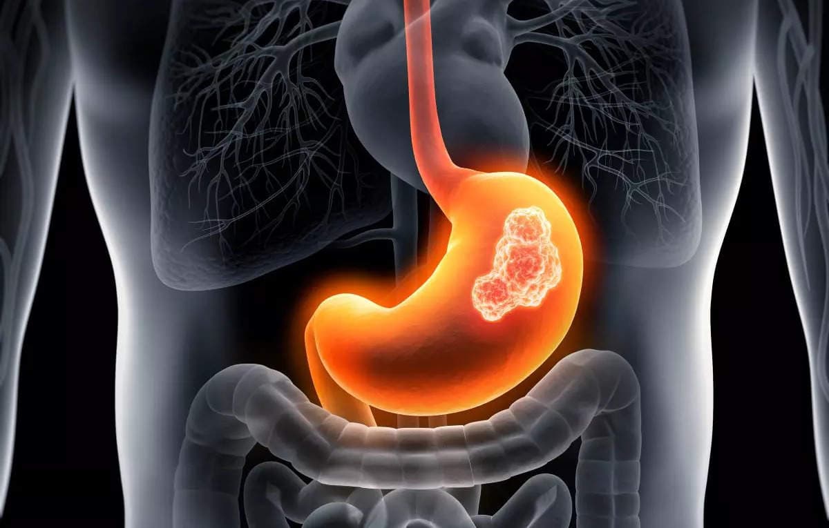 What happens after Gastrectomy?