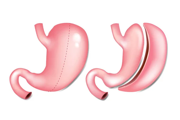 Gastrectomy benefits