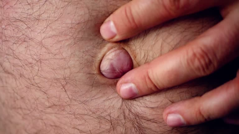 What are the types of hernia surgery?