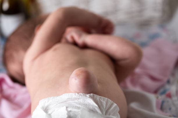 How to prepare for Hernia Repair?