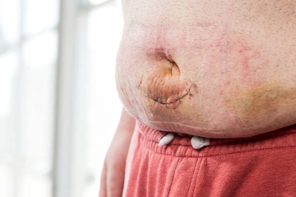 Hernia Repair benefits