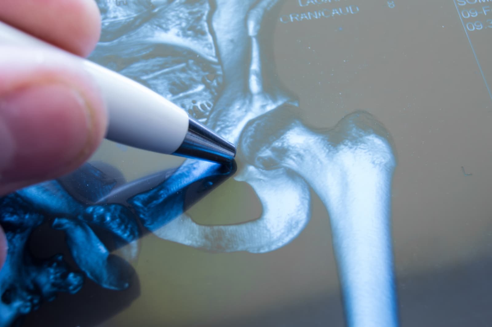What is joint replacement?