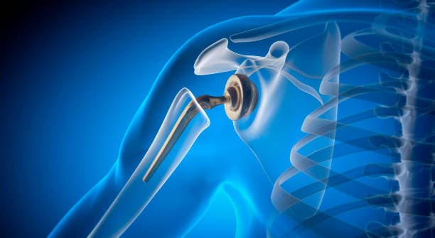 What to expect from a joint replacement surgery?