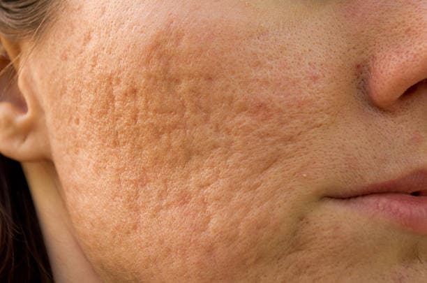 What are the types of acne?