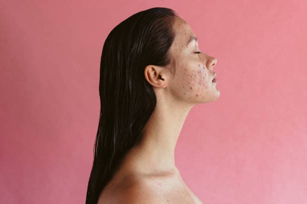 On which parts of the body does acne appear?