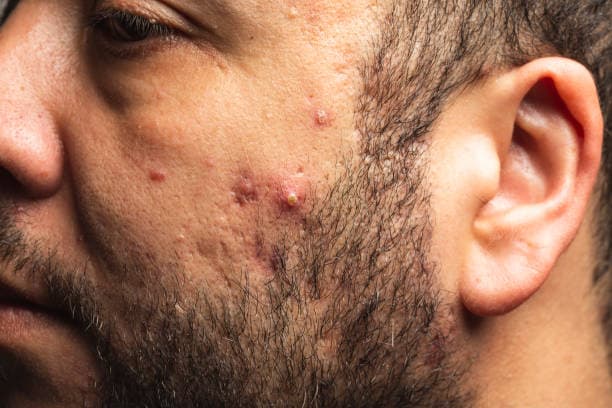 What causes acne?