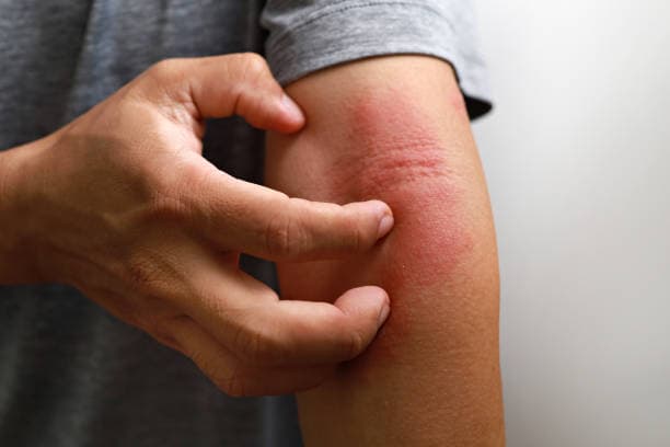 What are the types of eczema?
