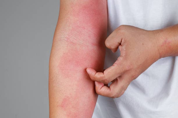 What causes eczema?