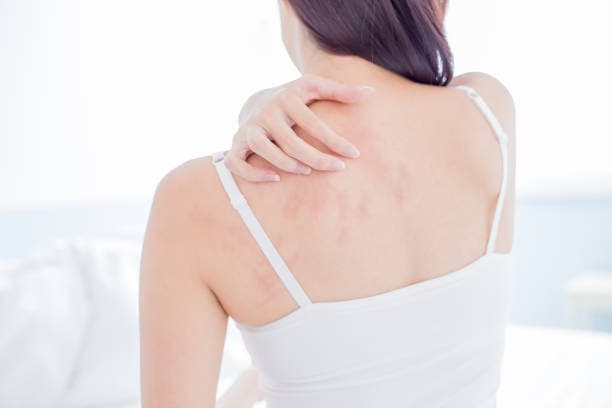 How is eczema diagnosed?