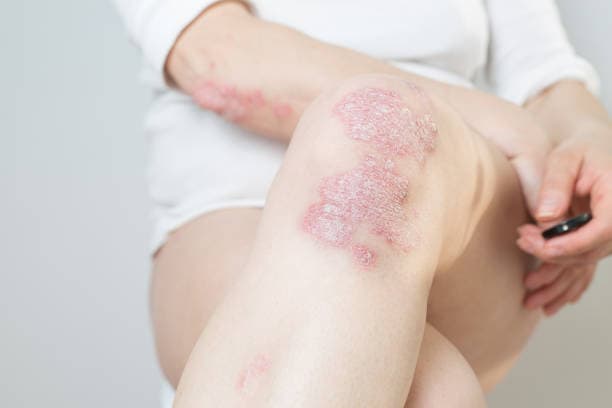 What parts of the body does psoriasis affect?