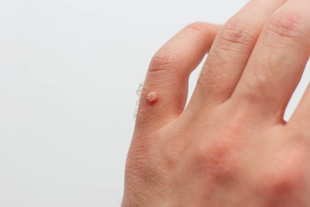What are Warts?