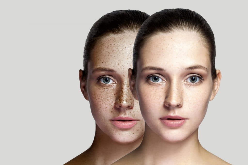 What are the types of melasma?