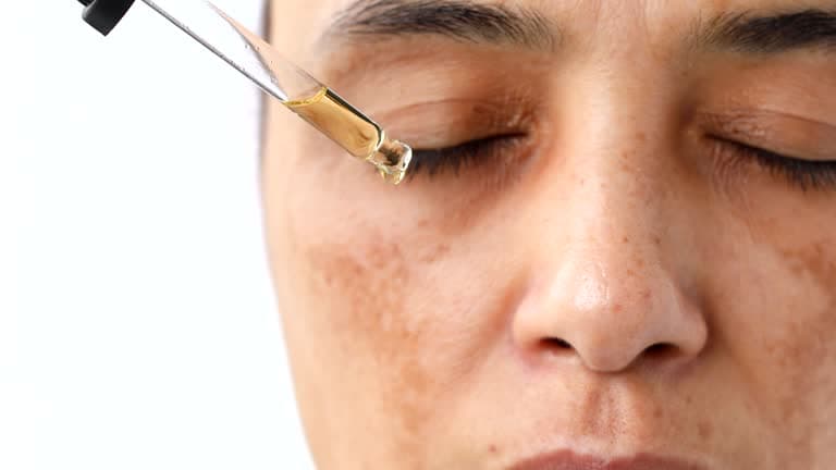 How is melasma treated?