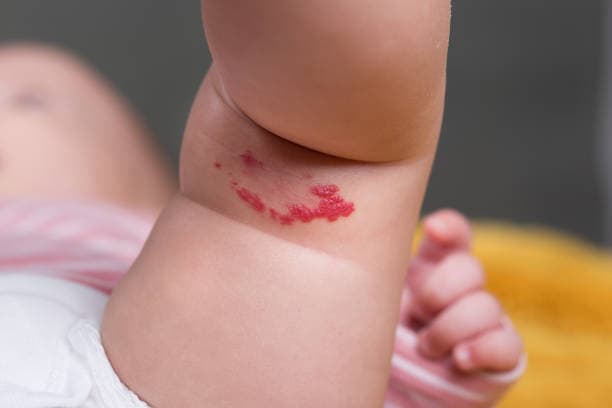 What is a hemangioma?