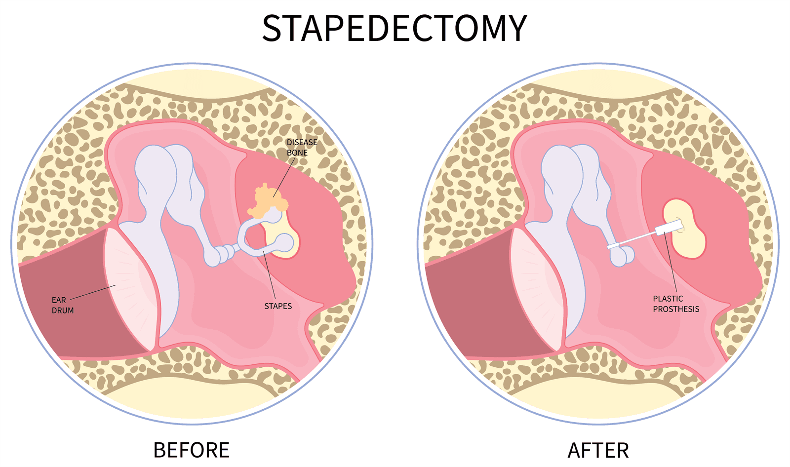 Stapedectomy procedure
