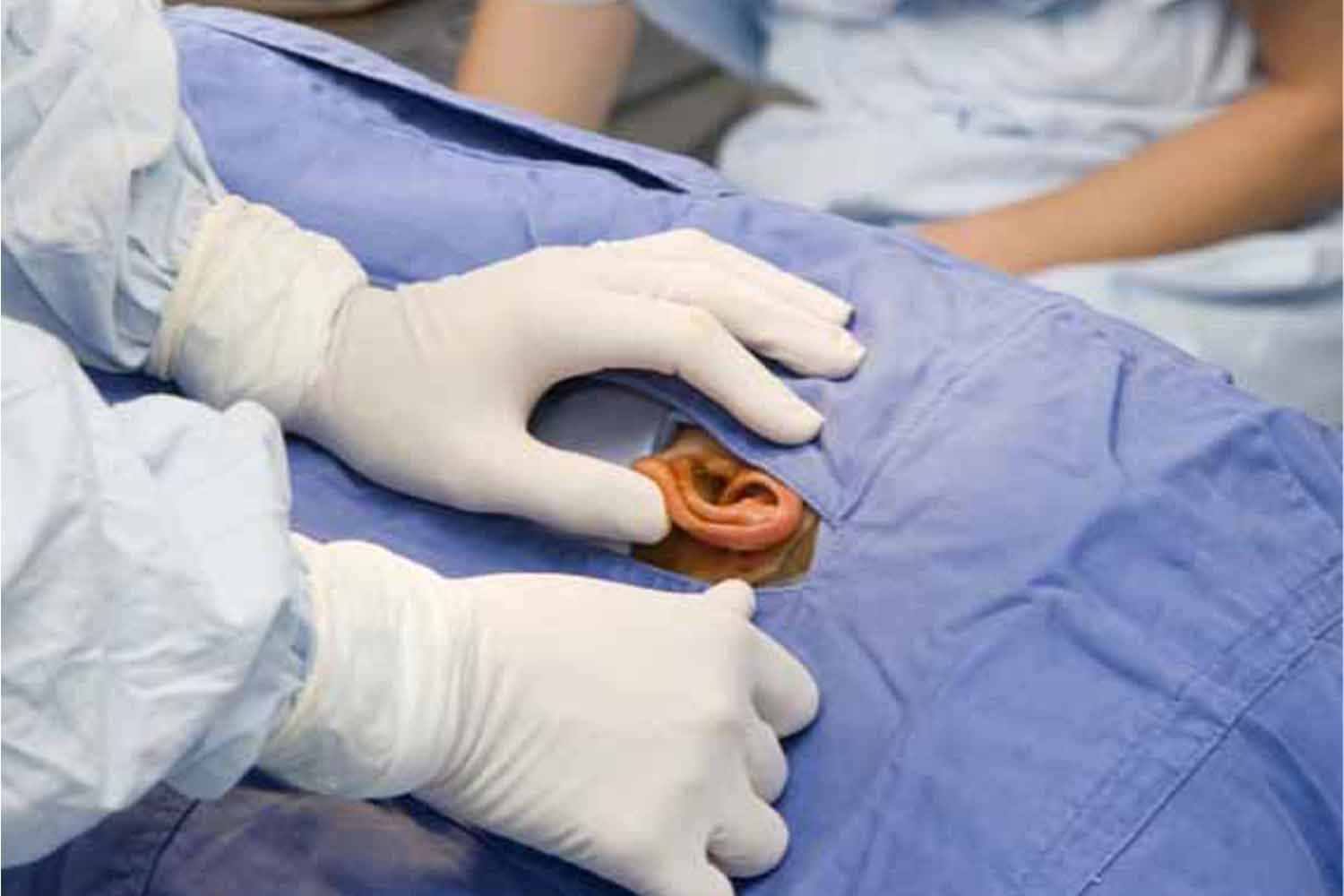 Stapedectomy cost in Iran