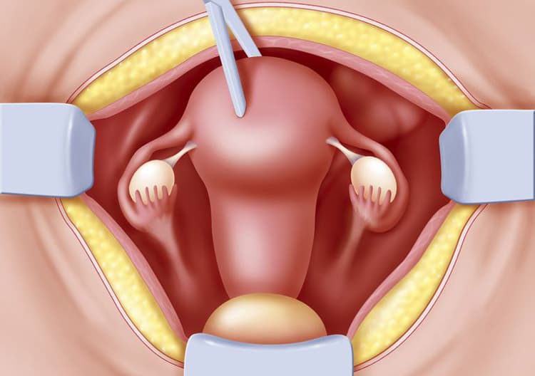 Why is Hysterectomy performed?
