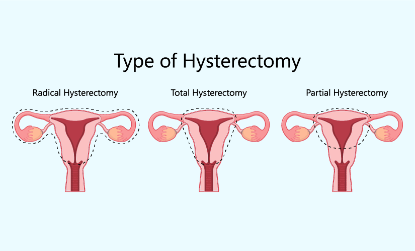 Recovering from a hysterectomy