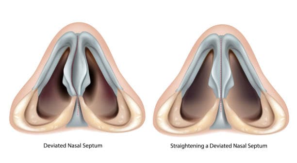 What happens during Septoplasty Procedure?