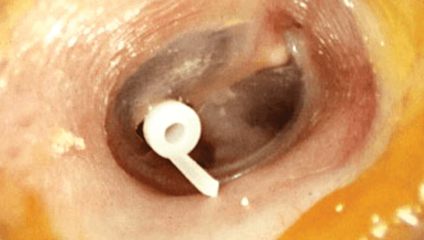 Myringotomy cost in Iran