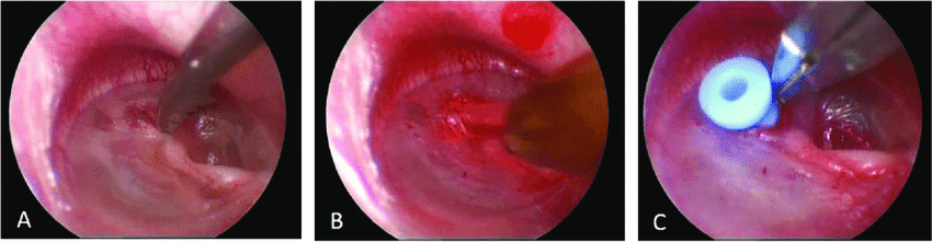 What is myringotomy?