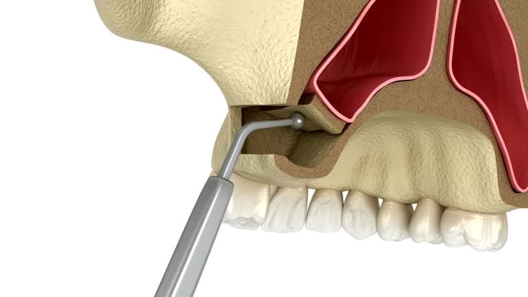 Surgery steps for different types of sinus surgery 
