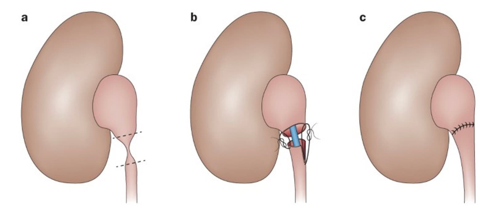 pyeloplasty risks & complications
