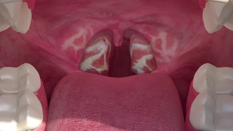 What is a tonsillectomy?