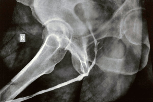 Why is an urethroplasty done?