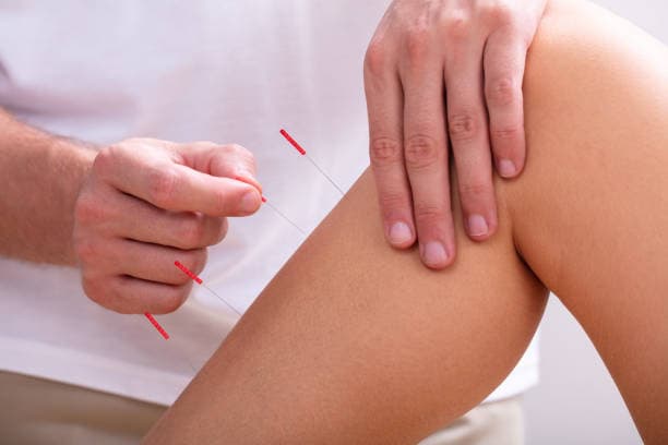 What happens during Acupuncture?