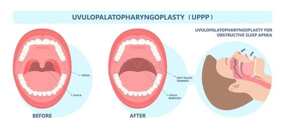 Uvulopalatopharyngoplasty (UPPP) cost in Iran