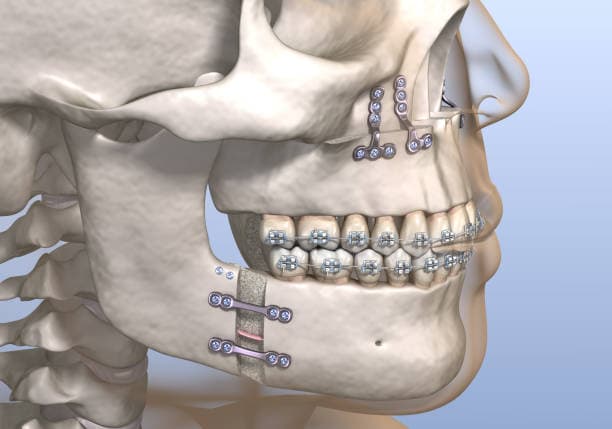 What happens during jaw surgery?