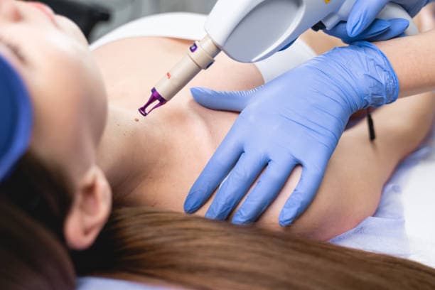 Mole Removal cost in Iran