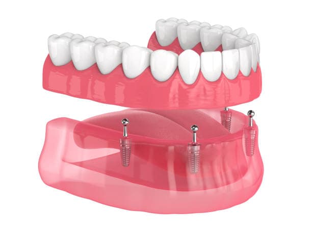 What happens during a denture consultation?